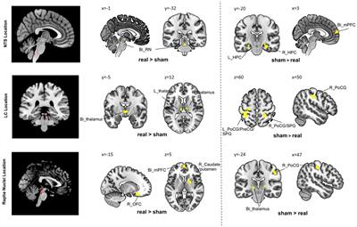 The modulation effects of repeated transcutaneous auricular vagus nerve stimulation on the functional connectivity of key brainstem regions along the vagus nerve pathway in migraine patients